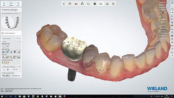 primenenie-3d-printera-v-stomatologii-3
